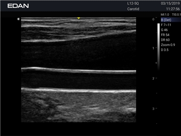 EDAN Acclarix LX25